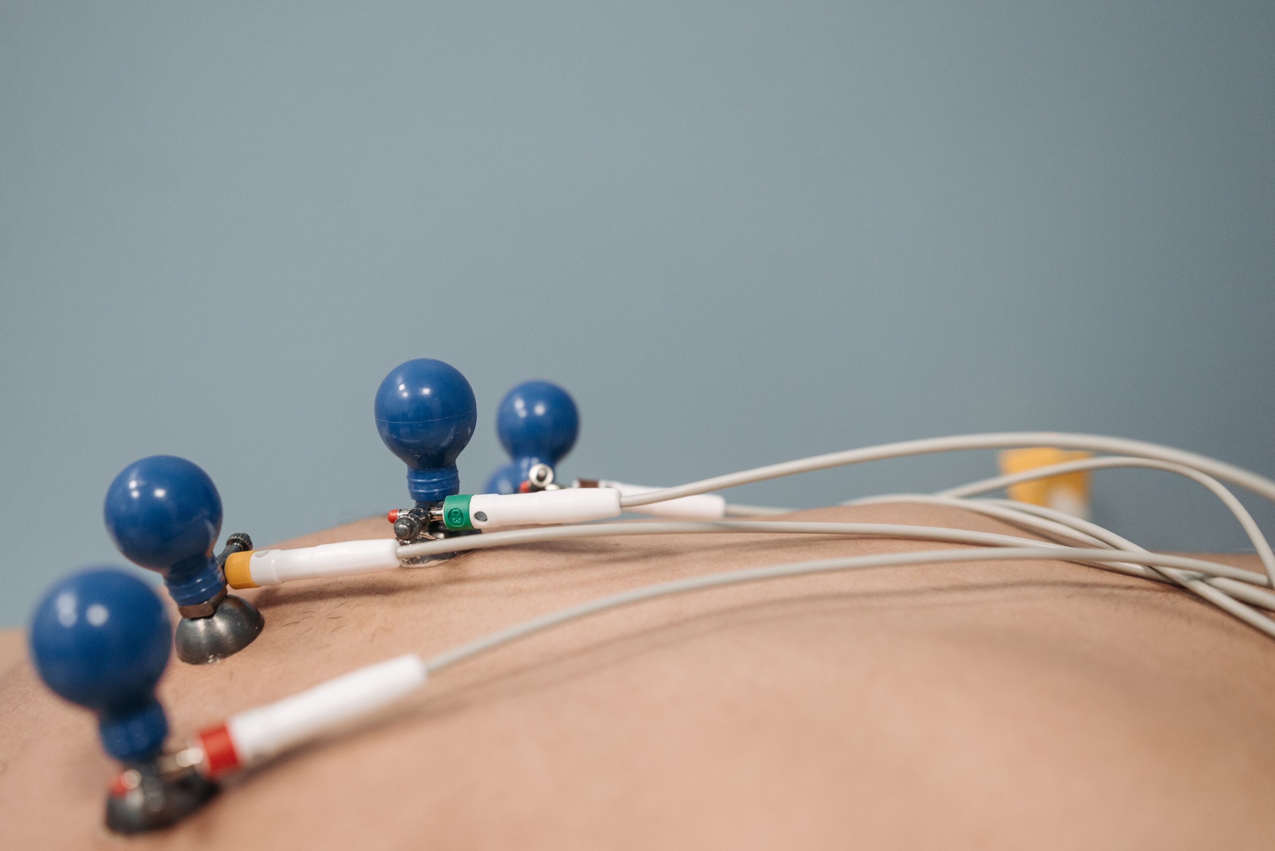 Electrodos de ECG colocados en el pecho de un paciente para la monitorización de signos vitales en tiempo real.